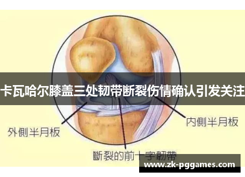 卡瓦哈尔膝盖三处韧带断裂伤情确认引发关注